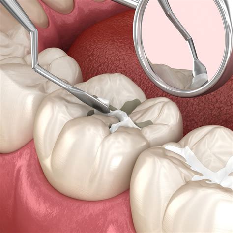 Odontología Conservadora — Clínica Dental Morandeira Dentista En Burgos