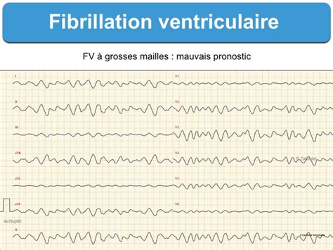 fibrillation ventriculaire fv e cardiogram