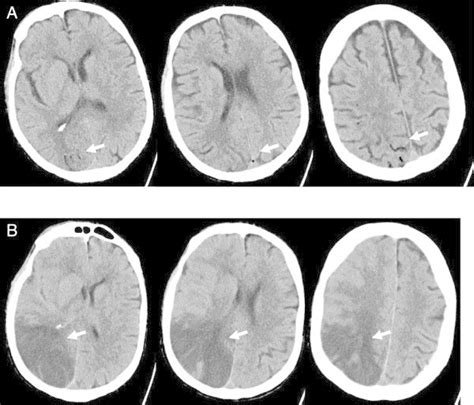 Ct In Cerebral Air Embolism Via Ercp Panel A Native Axial Ct Scan Of