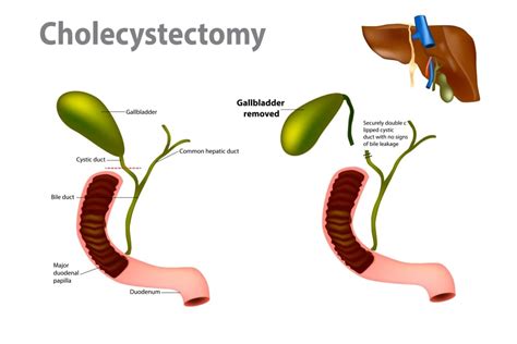 Cholecystectomy Top Surgeon Dr Dasari