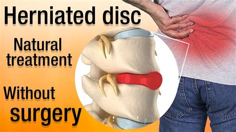 How To Heal A Herniated Disc Naturally Treatment And Recovery Youtube
