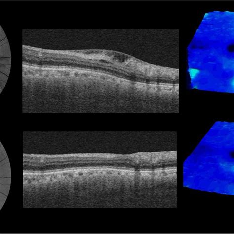 Serial Red Free Fundus Photographs First Column Swept Source Optical