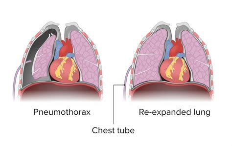 Pneumothorax Chest Tube Placement