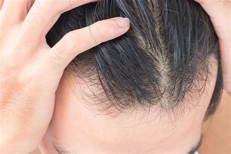 5 Root Causes Of Hair Thinning And What To Do About It Ds Healthcare