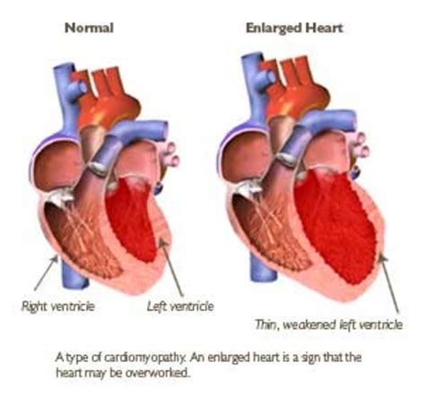 Heart Failure Congestive Heart Failure