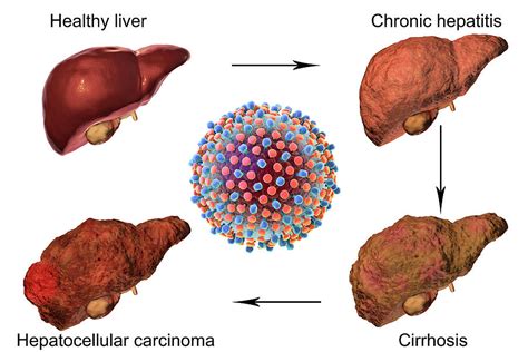 Stages Of Liver Disease In Hepatitis C Photograph By Kateryna Kon Science Photo Library