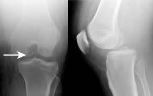 A Painful Swollen Knee After A Fall The Bmj