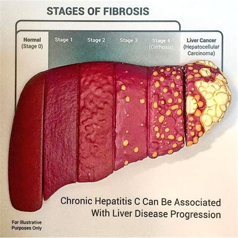 Liver Fibrosis Archives Dssurgery