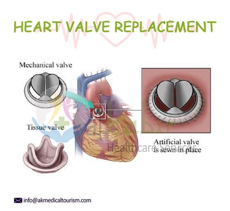Heart Valve Replacement Cost In India Heart Valves Mitral Valve