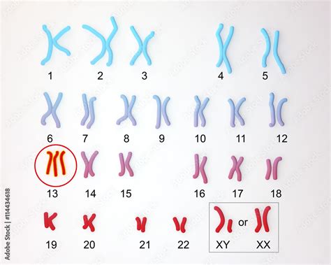 Patau Syndrome Karyotype Male Or Female Labeled Trisomy 13 3D