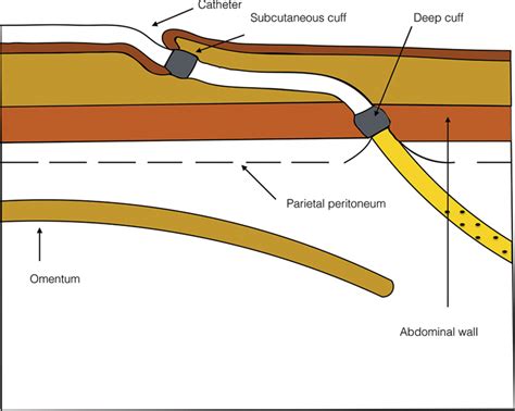 Peritoneal Dialysis Catheters Intechopen