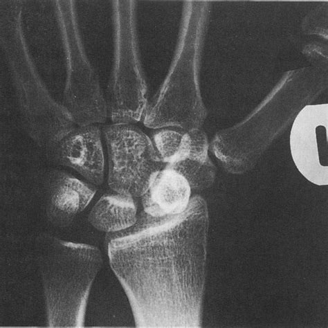 Postero Antenor Radiograph Of The Left Wrist Demonstrating Ring Sign