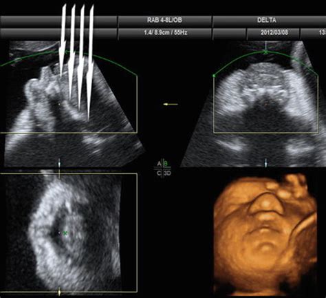 The Role Of 2d3d4d Ultrasound In The Prenatal Assessment Of Cleft Lip