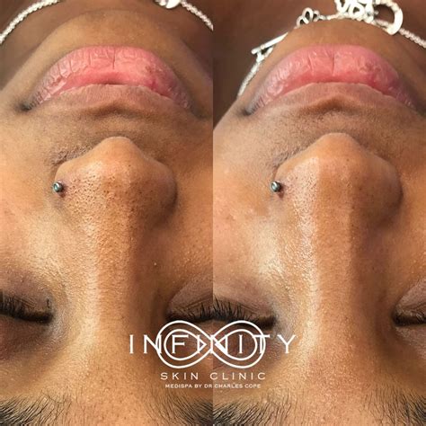 HydraFacial Before and After Images | Infinity Skin Clinic