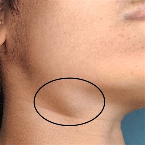 Clinical Picture Showing Right Submandibular Swelling Download