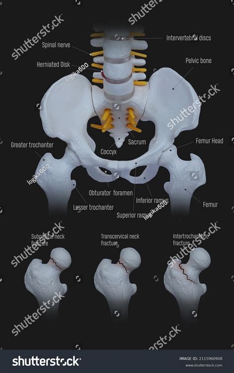 Hip Fracture Pelvis Bone Anatomy Sacrum Stock Photo Edit Now 2115960908