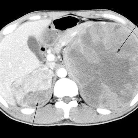 Abdominal Computed Tomography Scan With Intravenous Contrast Showing A