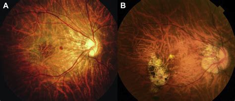 Peripapillary Diffuse Chorioretinal Atrophy In Children As A Sign Of