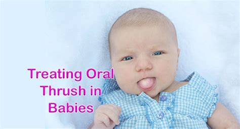 What You Need To Know About Thrush In Babies American Pregnancy
