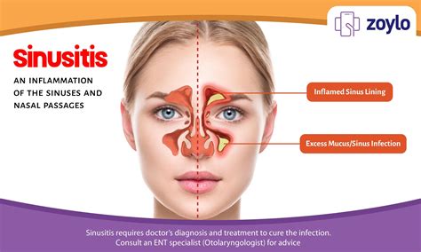 Sinusitis An Inflammation Of The Sinuses And Nasal Passages Sinus