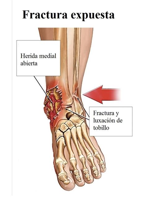 Fractura De Peron Descubre Aqu Las Causas S Ntomas Y Tratamientos
