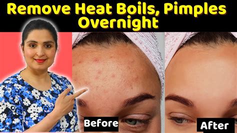 Cure Prickly Heat Rashes Sweat Pimples Heat Boils Ancient Remedy To