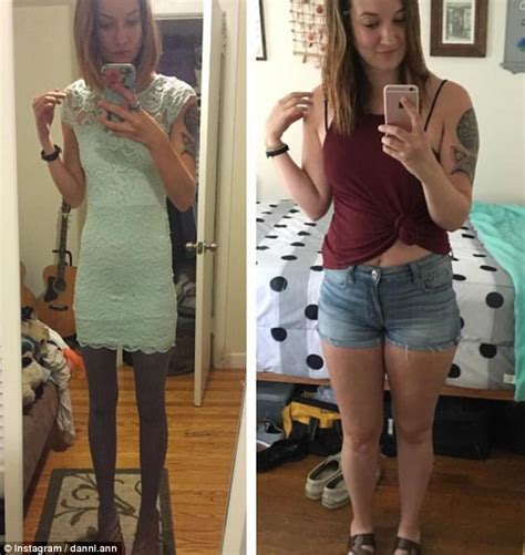 Bulimia Before And After