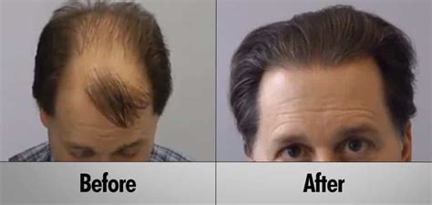 Hair Transplant Photo Gallery Hair Transplant Toronto Voted Best Hair Restoration Toronto
