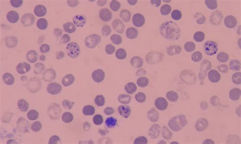 Reversible Pancytopenia Caused By Severe Copper Deficiency In A Patient