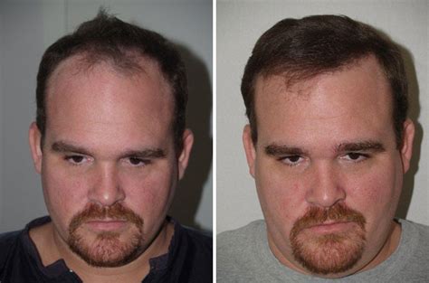 Hair Transplants For Men Photos Miami Fl Patient37655