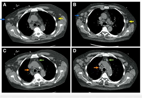 Ct Scan Of The Chest Increased Bilateral Axillary Adenopathies Blue