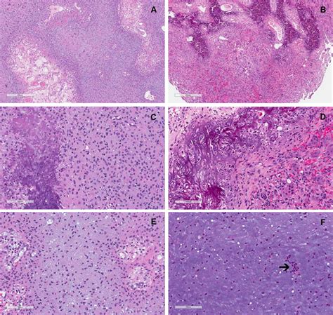 Histologic Features And Differential Diagnosis Of Chondromyxoid Fibroma