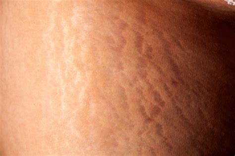 Pregnancy Stretch Marks Causes Prevention And Care Akusi Organics
