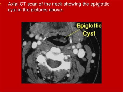 Larynx Imaging 2nd Part Laryngeal Congenital Inflammatory Traumatic C