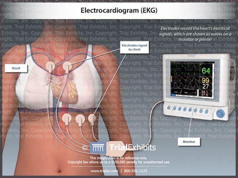 Electrocardiogram Ekg Trialexhibits Inc