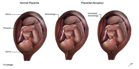 Placental abruption (abruptio placentae) is an uncommon yet serious complication of pregnancy. Abruptio Placentae - Obstetrics - Medbullets Step 2/3