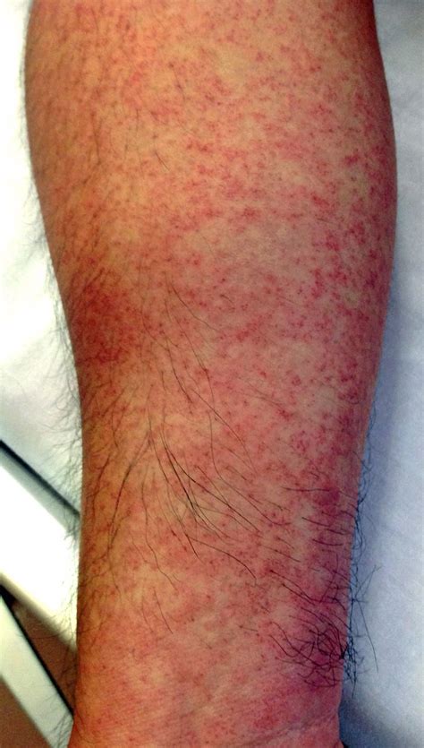 Skin Rash From Dengue Fever Bmj Case Reports