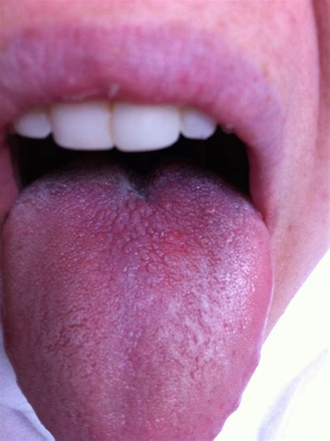 Red Bumps On The Back Of My Tongue