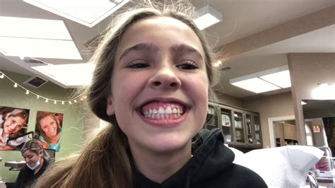 Allie Gets Her Braces Off Youtube