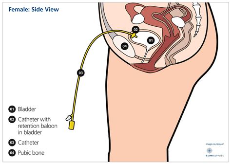 How Do You Code A Suprapubic Catheter Mastery Wiki