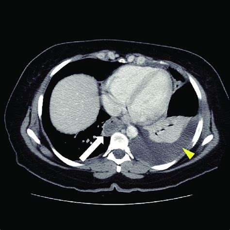 Abdominal CT Thickening Of Distal Esophagus White Arrow Is Evident Download Scientific