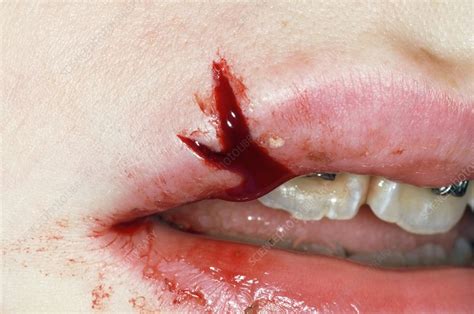 Split Lip After A Fall Stock Image C003 3047 Science Photo Library