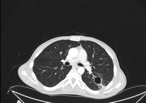 Axial Cut Of Ct Chest Without Intravenous Contrast Showing Clearing Of