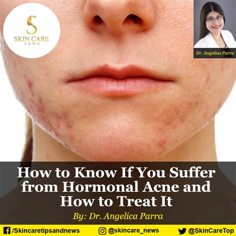 How To Know If You Suffer From Hormonal Acne And How To Treat It