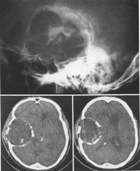 Giant Intradiploic Epidermoid Cysts Of The Skull In Journal Of