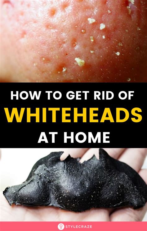 25 Best Remedies To Get Rid Of Whiteheads On Face And Nose In 2020