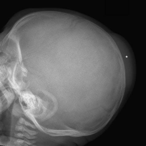 Delayed Infant Subaponeurotic Subgaleal Fluid Collections A Case
