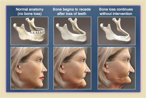 Movable Lump On Jaw Bone That Hurts Silopezombie