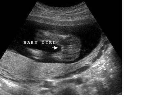How Do We Differentiate Genders On Ultrasound Catch A Glimpse
