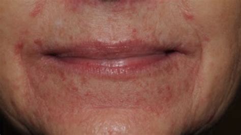 61 Year Old Female With 5 Day History Of Sudden Pruritic Rash Around Mouth And Eyelids The